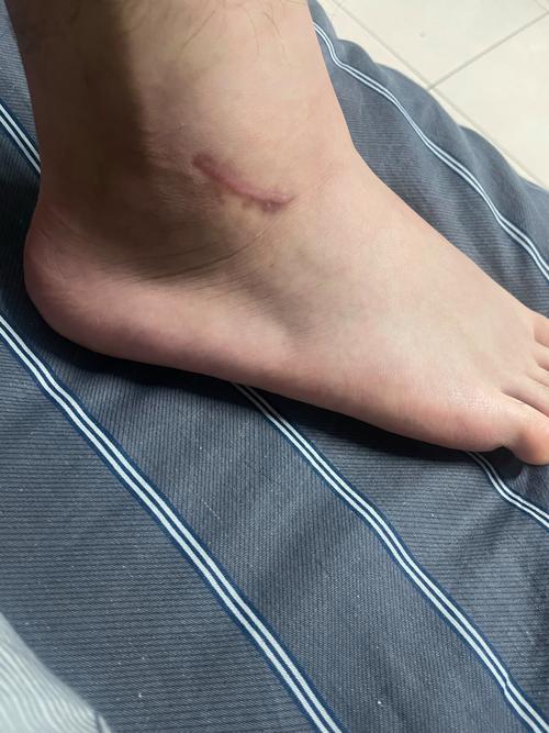 穆西亚拉腓骨骨折+韧带受伤预计伤缺4-5个月的简单介绍